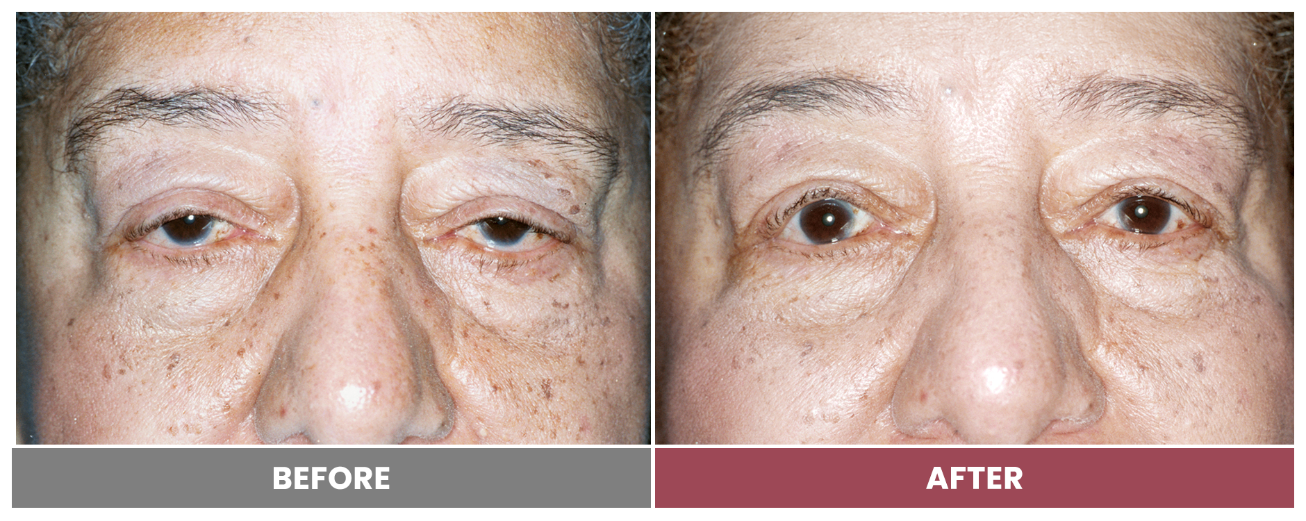 PTOSIS REPAIR - Case 9